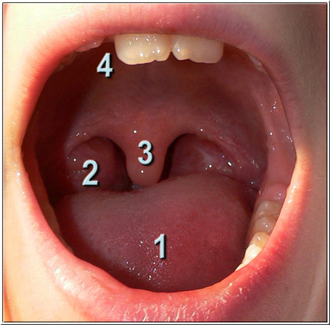 uette ou uvule, chez un enfant de 7 ans, et amygdales ou tonsilles palatines